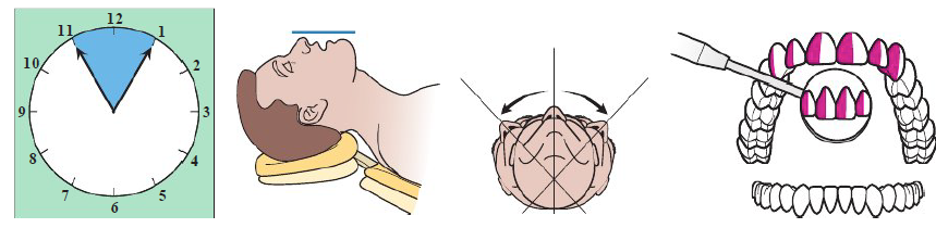<ul><li><p>Clinician sits 11 to 1 o’clock position</p></li><li><p>Patient chin UP</p></li><li><p>Maxillary occlusal perpendicular to floor</p></li><li><p>Patient head: Neutral, left, or right</p></li></ul><p></p>
