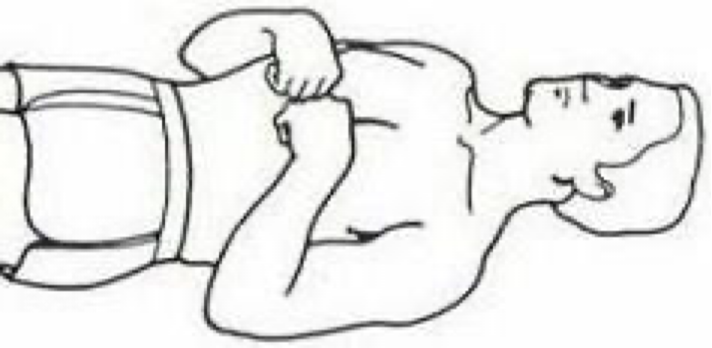 <ul><li><p>the brain at corticospinal tract</p></li><li><p>serious, but more favorable than decerebate posture</p></li><li><p>may progress to decerebrate posture, or the two may alternate</p></li></ul><p></p>