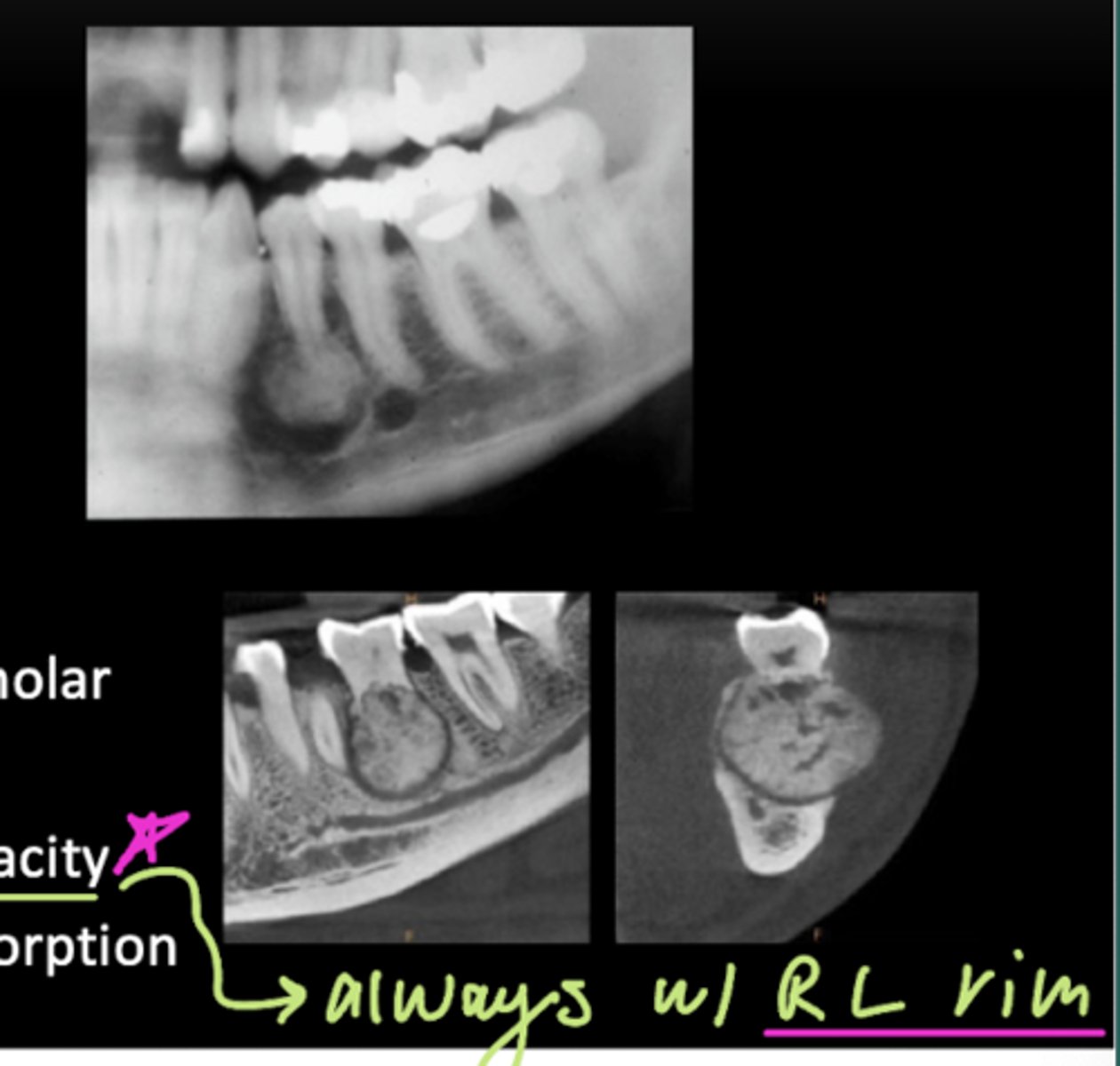 <p>- Location: often mandibular molar or premolar</p><p>- Density: mixed RL-RP</p><p>- Internal architecture: large central radiopacity</p><p>- Effect on surrounding structures: root resorption</p>