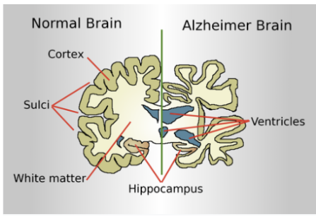 <p><span style="background-color: inherit; line-height: 20.7px; color: windowtext;">The brain of someone with Alzheimer's disease has:</span><span style="line-height: 20.7px; color: windowtext;"> </span></p><ul><li><p class="Paragraph SCXO101259042 BCX0" style="text-align: left;"><span style="background-color: inherit; line-height: 20.7px; color: windowtext;">Severe loss of hippocampal tissue -</span><span style="line-height: 20.7px; color: windowtext;"> </span></p></li></ul><p class="Paragraph SCXO101259042 BCX0" style="text-align: left;"><span style="background-color: inherit; line-height: 20.7px; color: windowtext;">--> this explains their inability to retrieve previously stored explicit memories + inability to form new explicit memories</span><span style="line-height: 20.7px; color: windowtext;"> + </span><span style="background-color: inherit;">loss of 'episodic future thinking'</span></p><p class="Paragraph SCXO101259042 BCX0" style="text-align: left;"></p><ul><li><p class="Paragraph SCXO101259042 BCX0" style="text-align: left;"><span style="background-color: inherit; line-height: 20.7px; color: windowtext;">Brain atrophy (brain shrinkage) - less cortical (cortex) matter</span><span style="line-height: 20.7px; color: windowtext;"> </span></p></li><li><p class="Paragraph SCXO101259042 BCX0" style="text-align: left;"><span style="background-color: inherit; line-height: 20.7px; color: windowtext;">Enlarged ventricles (fluid-filled spaces in the brain)</span><span style="line-height: 20.7px; color: windowtext;"> </span></p></li><li><p class="Paragraph SCXO101259042 BCX0" style="text-align: left;"><span style="background-color: inherit; line-height: 20.7px; color: windowtext;">Neocortex is damaged – affects their ability to store semantic memories + generating voluntary mental imagery</span><span style="line-height: 20.7px; color: windowtext;"> </span></p></li><li><p class="Paragraph SCXO209764317 BCX0" style="text-align: left;"><span style="background-color: inherit; line-height: 20.7px; color: windowtext;">Damage to parietal lobes – linked with problems with spatial memory (e.g. likely to get lost in familiar surroundings)</span><span style="line-height: 20.7px; color: windowtext;"> </span></p></li><li><p class="Paragraph SCXO209764317 BCX0" style="text-align: left;"><span style="background-color: inherit; line-height: 20.7px; color: windowtext;">Damage to occipital lobes – difficulty recognising familiar people and objects</span><span style="line-height: 20.7px; color: windowtext;"> </span></p></li><li><p class="Paragraph SCXO209764317 BCX0" style="text-align: left;"><span style="background-color: inherit; line-height: 20.7px; color: windowtext;">In later stages, damage to cerebellum – leads to loss of implicit procedural functions</span><span style="line-height: 20.7px; color: windowtext;"> </span></p></li><li><p class="Paragraph SCXO209764317 BCX0" style="text-align: left;"><span style="background-color: inherit; line-height: 20.7px; color: windowtext;">Damage to hindbrain (brain stem) affects breathing and heartrate functions</span><span style="line-height: 20.7px; color: windowtext;"> </span></p></li></ul><p></p>