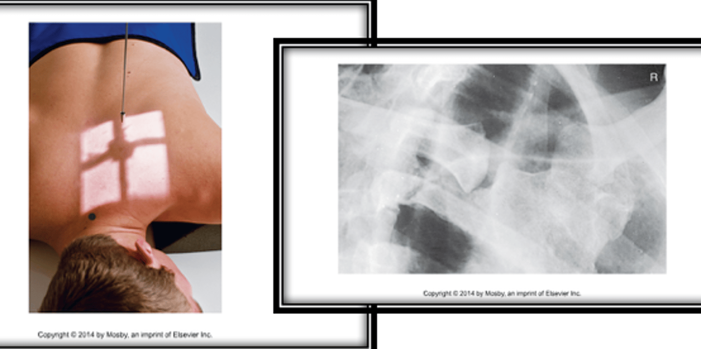 <p>- What is this exam?</p><p>- What is the SID?</p><p>- Is the patient shielded?</p><p>- How is the patient positioned?</p><p>- How many images are obtained and why?</p><p>- How many degrees is the patient obliqued?</p><p>- What does the RAO position demonstrate?</p><p>- What does the LAO position demonstrate?</p><p>- What is the CR?</p><p>- What are the breathing instructions?</p>