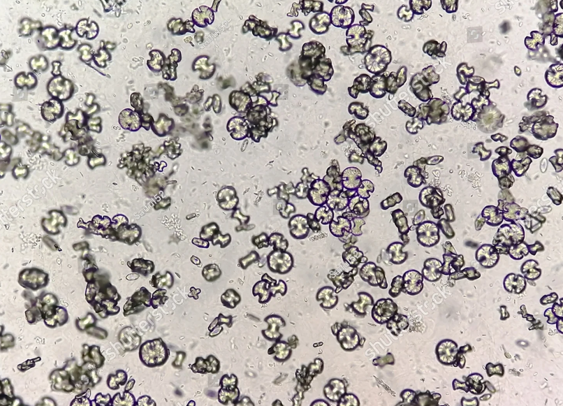 <p>These crystals appear oval or dumbbell shaped and are highly refractile. What type of crystal is this? The pH is 6.5</p>