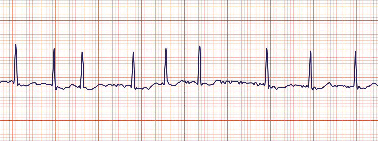 <p>What pathology is shown on the ECG? What are the defining characteristics?</p>