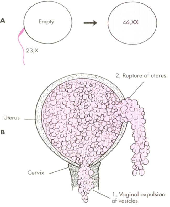 <p><span>noncancerous tumor that develops in the uterus due to abnormal fertilization, resulting in an abnormal placenta, no viable fetus, and grape-like cyst formation</span></p><ul><li><p><strong><em>No fetus develops!</em></strong></p></li><li><p>Abnormal fertilization of egg whose nucleus has been lost — sperm duplicates itself <em>very fast</em></p></li></ul><p></p>
