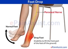 <p>COMMON FIBULAR NERVE </p><p>fibular head and neck = always think common fibular nerve</p>