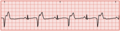 <p>The ventricles contract out of the normal sequence. A P wave is not visible and the QRS complexes are wide and bizarre</p>