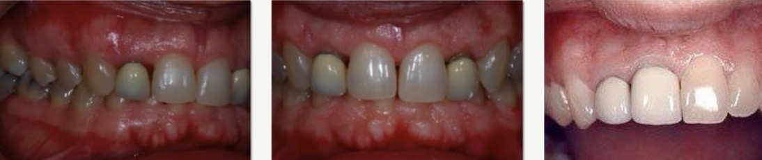 <p>High opacity</p><p>Corrosion of the chromium-nickel alloy</p><p>Decreased gingival biocompatibility</p><p>Greyish gingival margin: umbrella effect- has disadvantages and therefore other materials are used</p>
