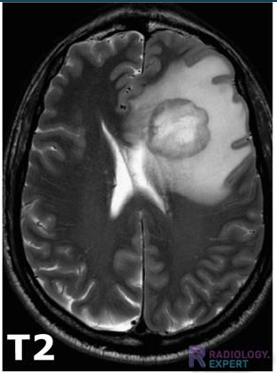 <p>MRI T2 weighted images</p>