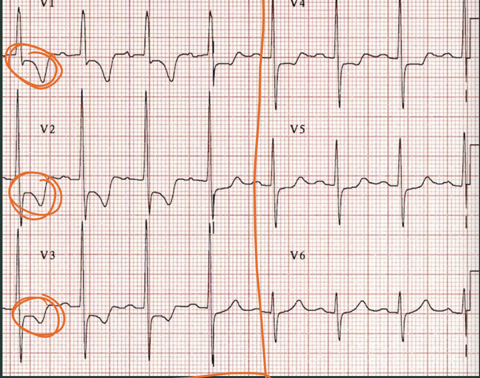 <p>What type of hypertrophy?</p>