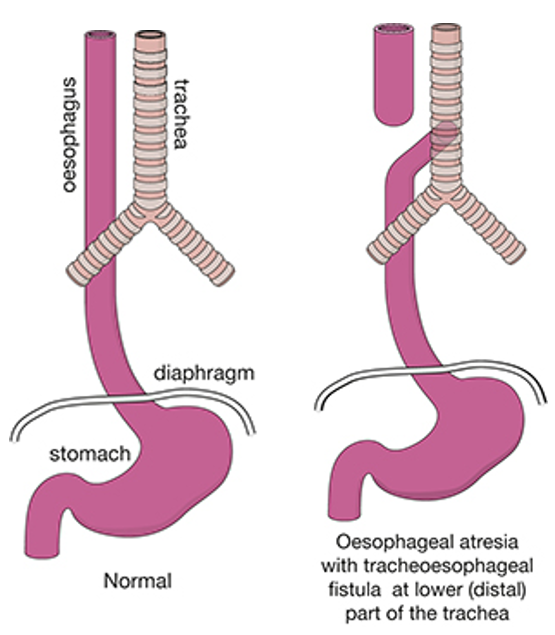 <p>esophageal atresia + tracheoesophageal fistula</p>