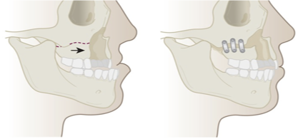 <p>What is this maxillary advancement technique?</p>