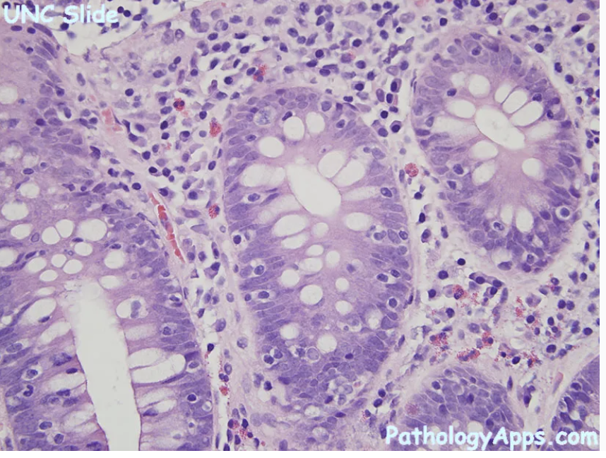 <p>1) diagnostic</p><p>2) histologie</p><p>3) cut off </p>