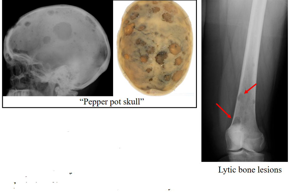 <p>Skeletal survey includes:</p><p>- Lateral skull</p><p>- Frontal chest film</p><p>- Cervical-thoracolumbar spine</p><p>- Shoulders</p><p>- Pelvis, femur</p><p>.</p><p>Majority of lesions are sharply defined and lytic</p>