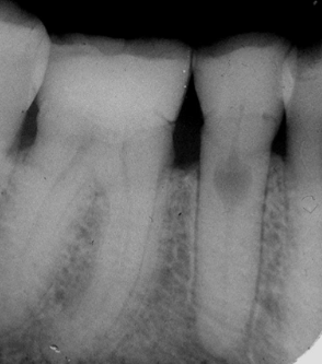 <p>rare, injury to pulpal tissue </p>