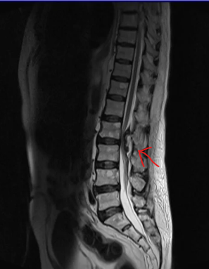 <p><strong>seroma</strong></p>