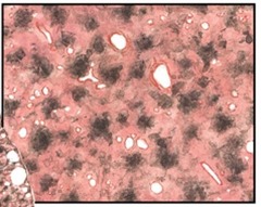 <p>This is a lung section from a patient lived in a heavily polluted area. Which of the following cell types accumulated the black pigments?</p>