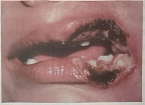 <p>BN 6y</p><p>Vết loét sâu</p><p>CHẨN ĐOÁN?</p>