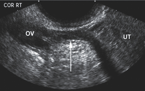 <p>9. The arrow in Figure 16-18 indicates the:</p><p>a. ovarian ligament.</p><p>b. round ligament.</p><p>c. uterosacral ligament.</p><p>d. broad ligament.</p>