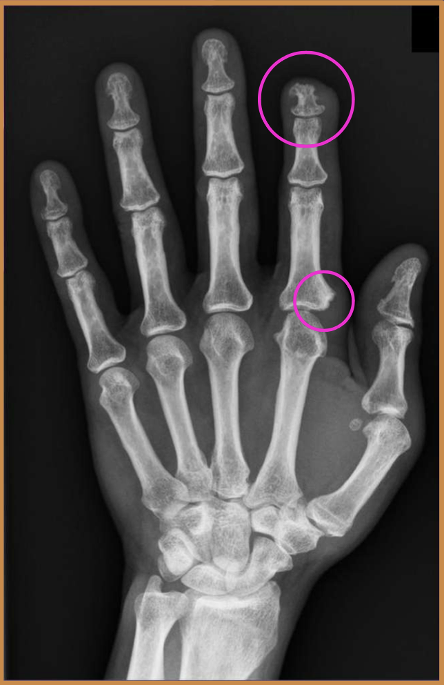 <p>What finding of PsA is found in this image</p>