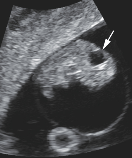 <p>9. What does the arrow in Figure 23-32 indicate?</p><p>a. Cephalic cyst</p><p>b. Thickened NT</p><p>c. Fourth ventricle</p><p>d. Choroid plexus cyst</p>