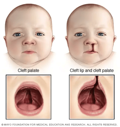 <p>cleft lip/palate</p>