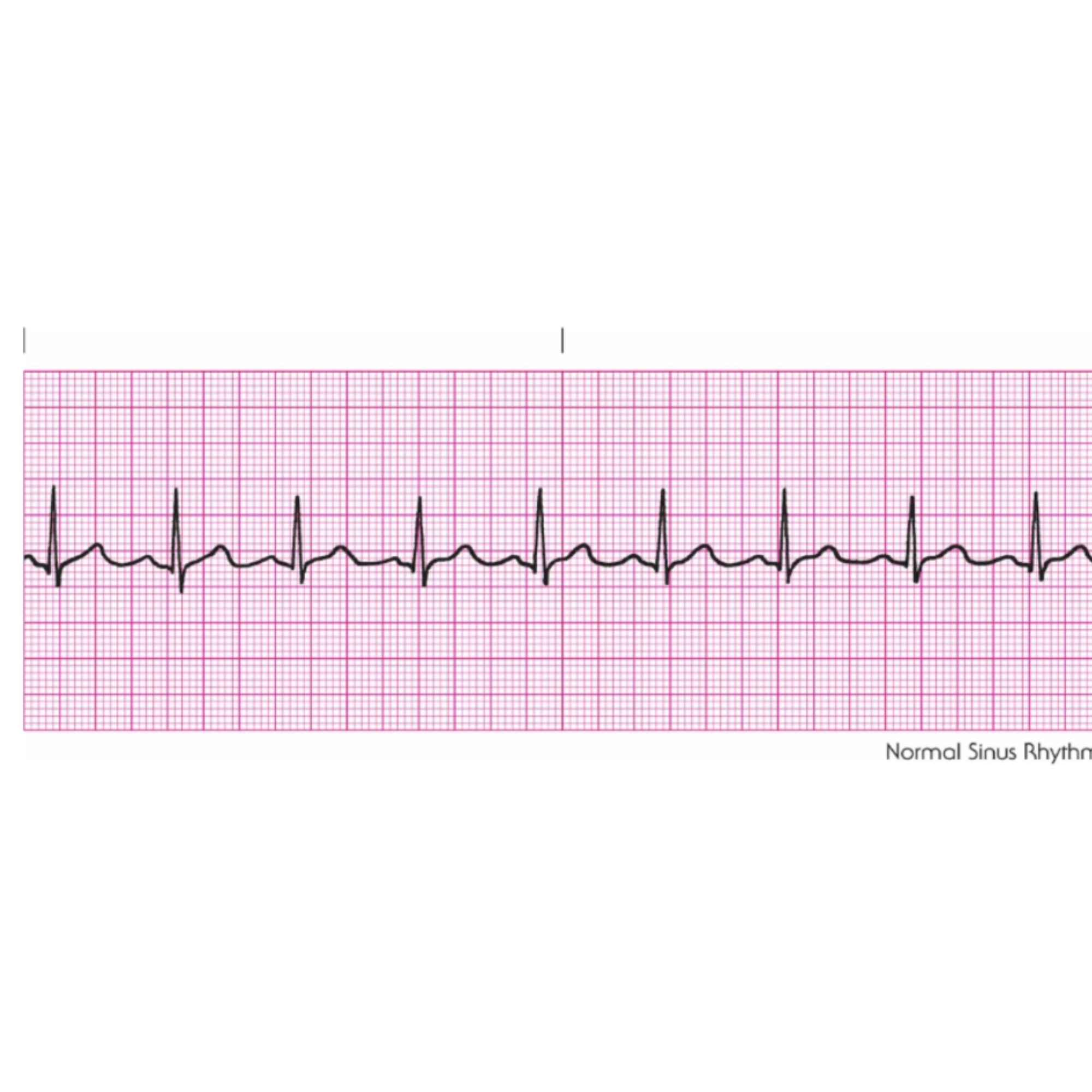 <p>Rules for Normal Sinus Rhythm is when </p>