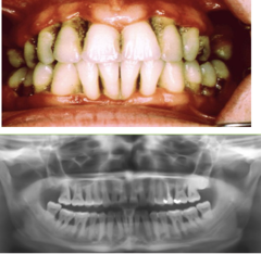 <p>Gingivitis or periodontitis?</p>