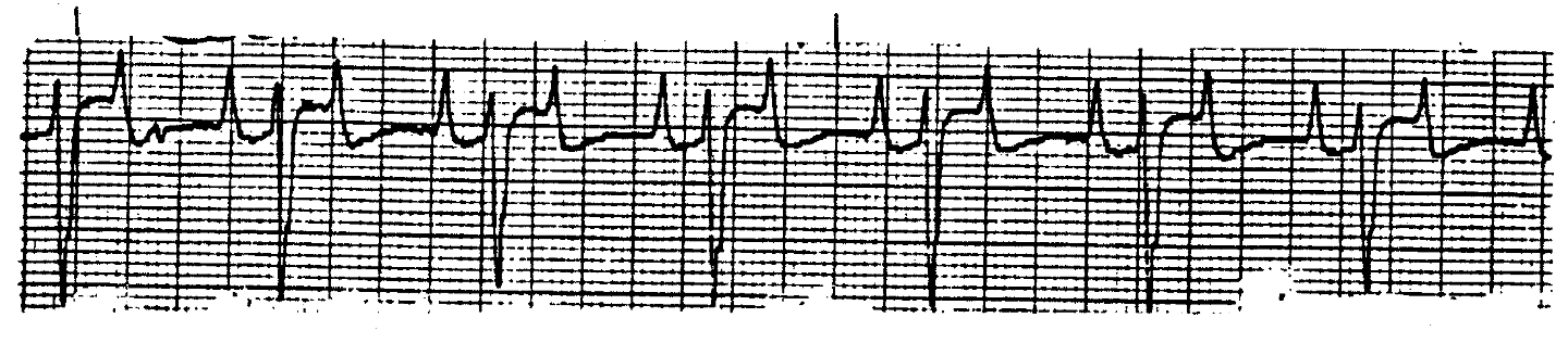 <p>What ECG is this? </p>