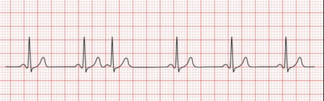 <p>the image shown depicts what cardiac arrhythmia? </p>