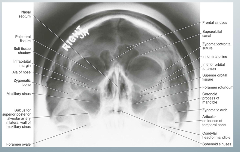 <p>-used to evaluate maxillary sinuses (can see without obstruction)</p>