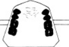 <p>Not replacing 3rd molars</p>