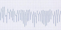<p>What is this ECG telling you</p>