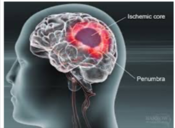 <p>the area of dead tissue following the stroke; tissue necrosis</p>