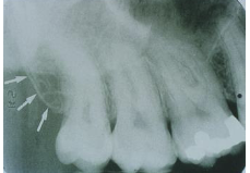 <p>Maxillary Tuberosity</p>