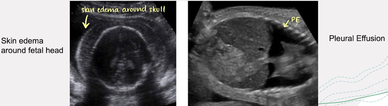 <ul><li><p>fluid in abdomen (ascites)</p></li><li><p>around the lungs (<span style="color: yellow;">pleural effusion</span>)</p></li><li><p>around the heart (pericardial effusion)</p></li><li><p>polyhydramnios</p></li></ul><p></p>