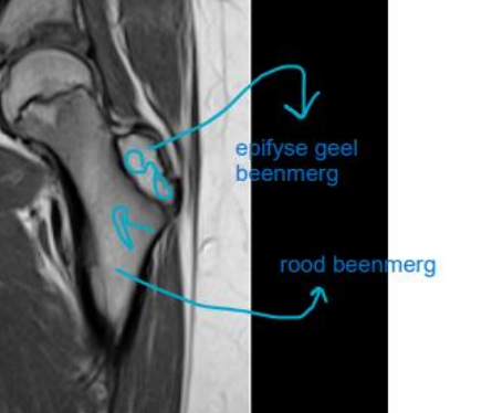 <ul><li><p>T1 rood: grijs</p></li><li><p>T1 geel: epifyse vetbeenmerg witter</p></li></ul><p></p>