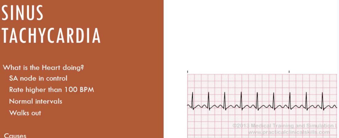 <p>sinus tachycardia</p>