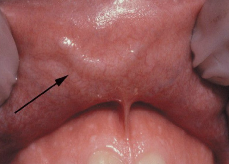 <p>common vascular anomaly seen in the upper or lower lip of adults </p>