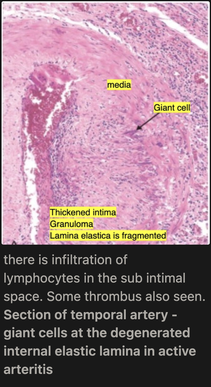 <p>Medial granulomatous inflammation (T cells and macrophages) leading to elastic lamina fragmentation/destruction</p>