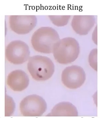 <p>-malaria; there’s decreased growth in RBCs of plasmodium falciparum</p>