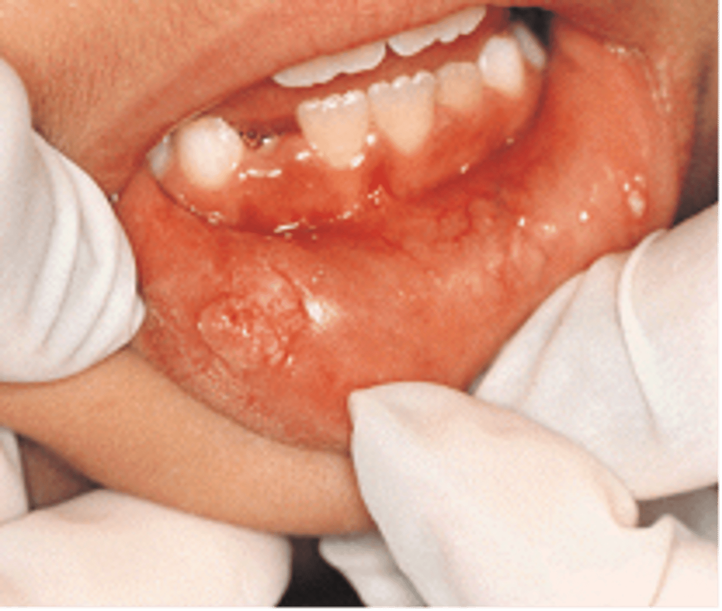 <p><span>lesion that appears as a result of human papilloma virus; on the skin, lesions appear as cauliflower-like warts, and on mucous membranes, they have a flat appearance; also known as venereal or genital warts</span></p>