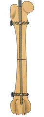 <p>-intermedullary rod with holes with bolts placed through both sides</p><p>-resists bending</p><p>-resists rotation</p><p>-resists tension</p><p>-resists compression</p>