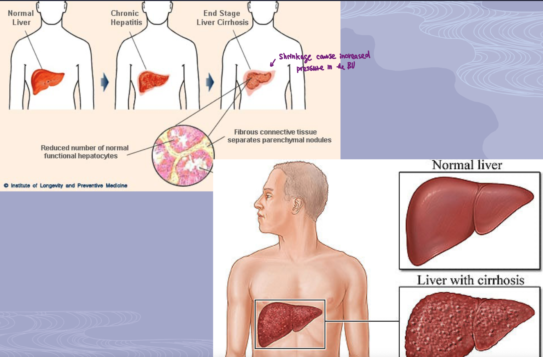 <p>cirrhosis progresses gradually because repeated liver injury continues to produce scar tissues → as fibrosis increases:</p><ol><li><p>liver blood flow becomes disrupted</p></li><li><p>liver function declines</p></li><li><p>complications such as portal hypertension and liver failure may develop</p></li></ol><p></p>