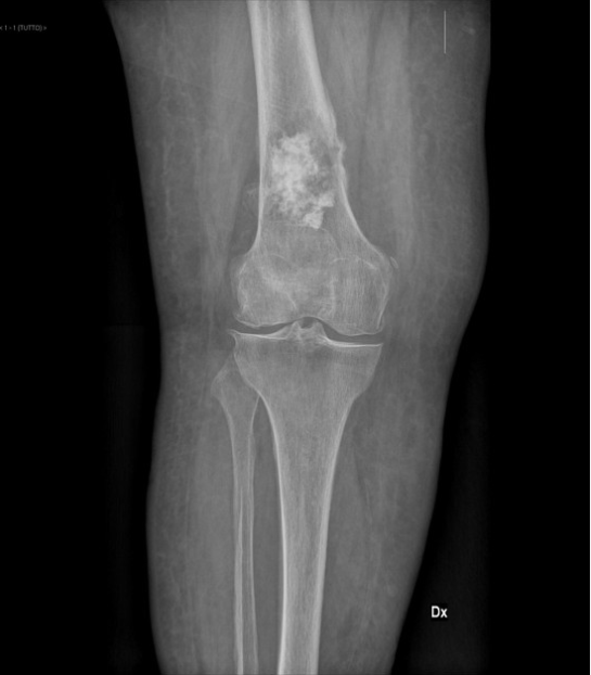 <p>> 40 y.o.; creates a spiculated/radiating/sunburst periosteal reaction of bone </p>