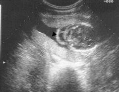 <p>The accumulation of fluid between the posterior cervical spine and the overlying skin in the fetal neck identified during an ultrasound examination. 2nd trimester finding, compared to NT which is measured in the first trimester</p>