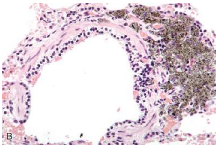 <p>Intracellular accumulations: Carbon</p>