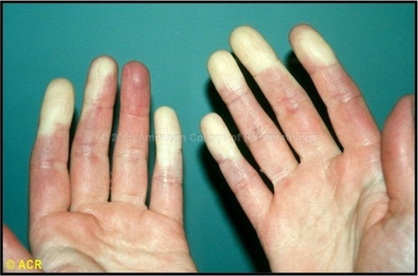 <p>digital cyanosis</p>