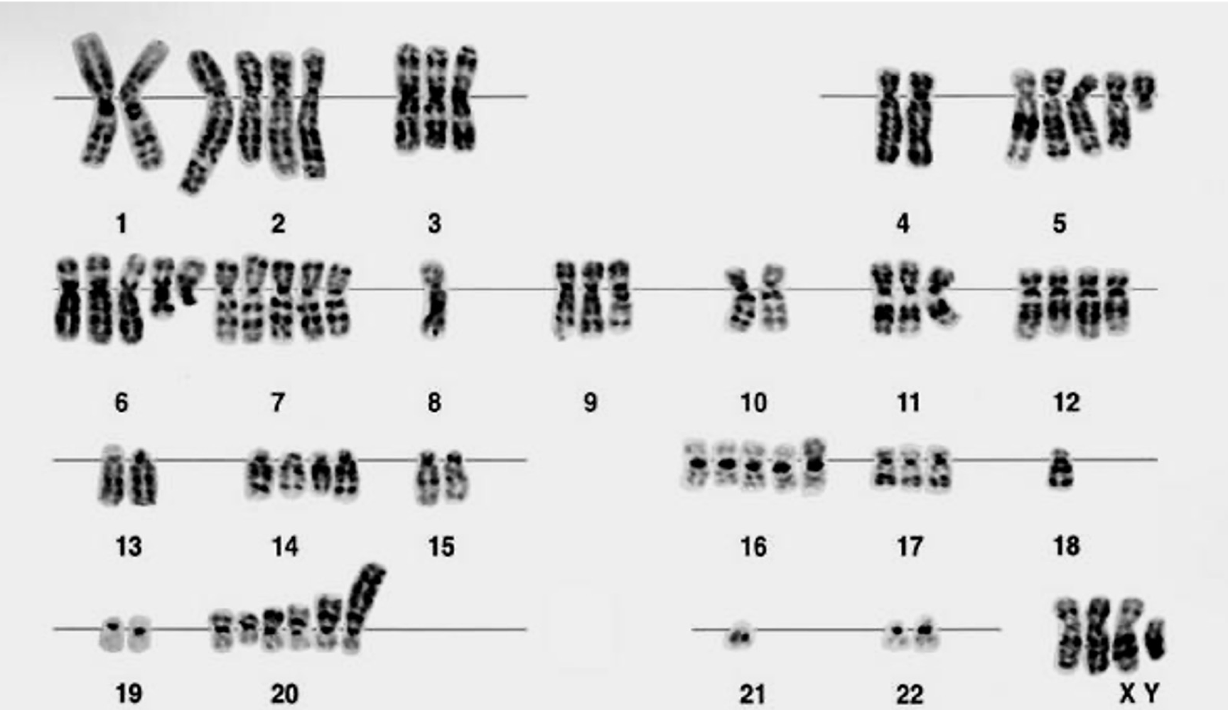 <p><u>Aaneuploïdie dans une cellule cancéreuse</u> : on observe des <strong>chromosomes surnuméraires</strong> (chr. 2, 3, 5, 7,...), <strong>pertes de chromosomes</strong> (chr. 8, 18, 21) et <strong>remaniements chromosomiques</strong> (chr. 2, 5, 6, 20)</p>