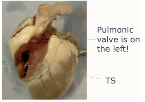 <ul><li><p><span style="background-color: transparent;">Crescent shaped in section</span></p></li><li><p><span style="background-color: transparent;">Wraps around the left ventricle cranial and to the right</span></p></li><li><p><span style="background-color: transparent;">Pulmonary artery is cranial and left of the aorta </span></p></li><li><p><span style="background-color: transparent;">Trabecular septomarginalis</span></p><ul><li><p><span style="background-color: transparent;">Septum- outer wall</span></p></li></ul></li></ul><p></p>