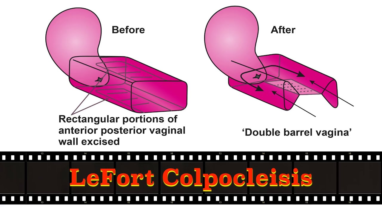 <p>The Le Fort procedure is a <strong><mark data-color="#fdfdfd" style="background-color: rgb(253, 253, 253); color: inherit;">partial colpocleisis</mark></strong>. It is an obliterative surgery for pelvic organ prolapse that sews together the anterior and posterior vaginal walls, creating small, narrow, lateral drainage tunnels for cervical secretions. It is often used for elderly women with a uterus who no longer wish to engage in sexual intercourse and also cannot undergo more extensive surgery.</p>